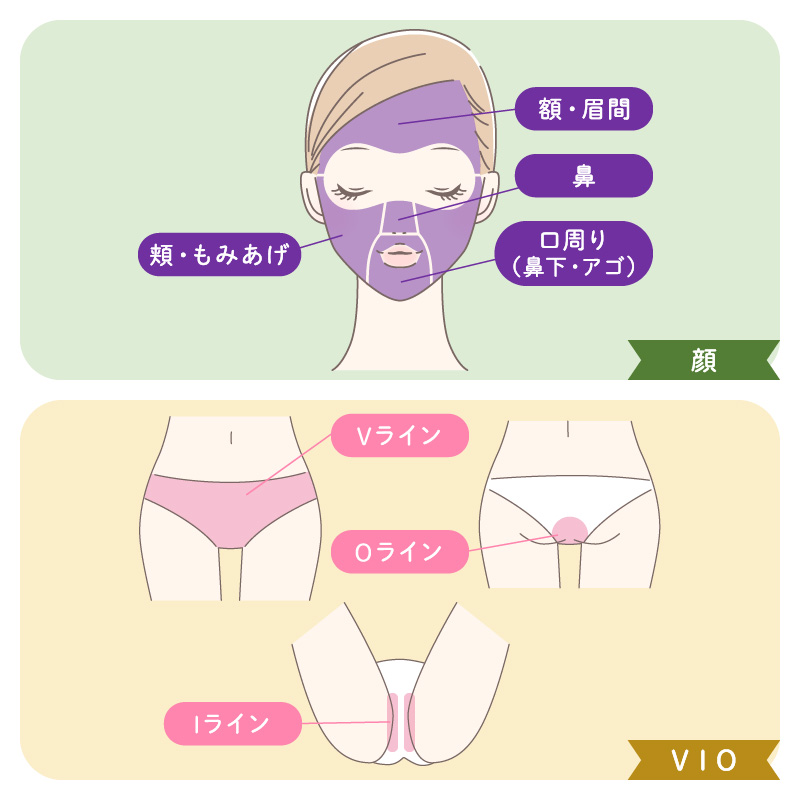 部位割パーツ脱毛範囲顔vio