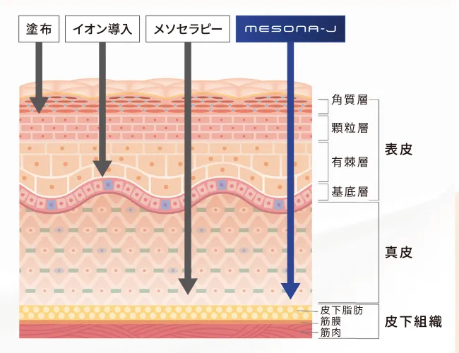 メソナJのメソポレーション法による導入治療の説明図です。イオン導入で肌の奥まで浸透できない高分子成分をエレクトロポレーションを応用した技術で浸透させます。