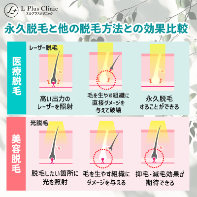 永久脱毛と他の脱毛方法との効果比較