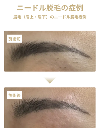 リゼクリニック公式_ニードル脱毛(医療針脱毛)