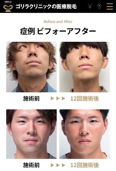 ゴリラクリニック-無料カウンセリング予約フォーム3
