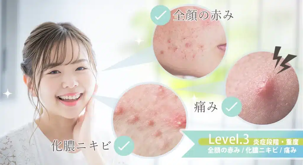 ニキビレベル3.炎症段階・重度（全顔の赤み・化膿ニキビ・痛み）