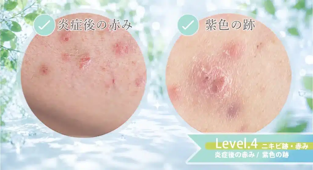 ニキビレベル4.ニキビ跡・赤み（炎症後の赤み・紫色の跡）