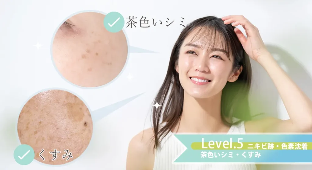 ニキビレベル5.ニキビ跡・色素沈着（茶色いシミ・くすみ）