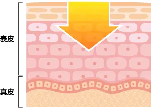サリチル酸マクロゴールの作用範囲